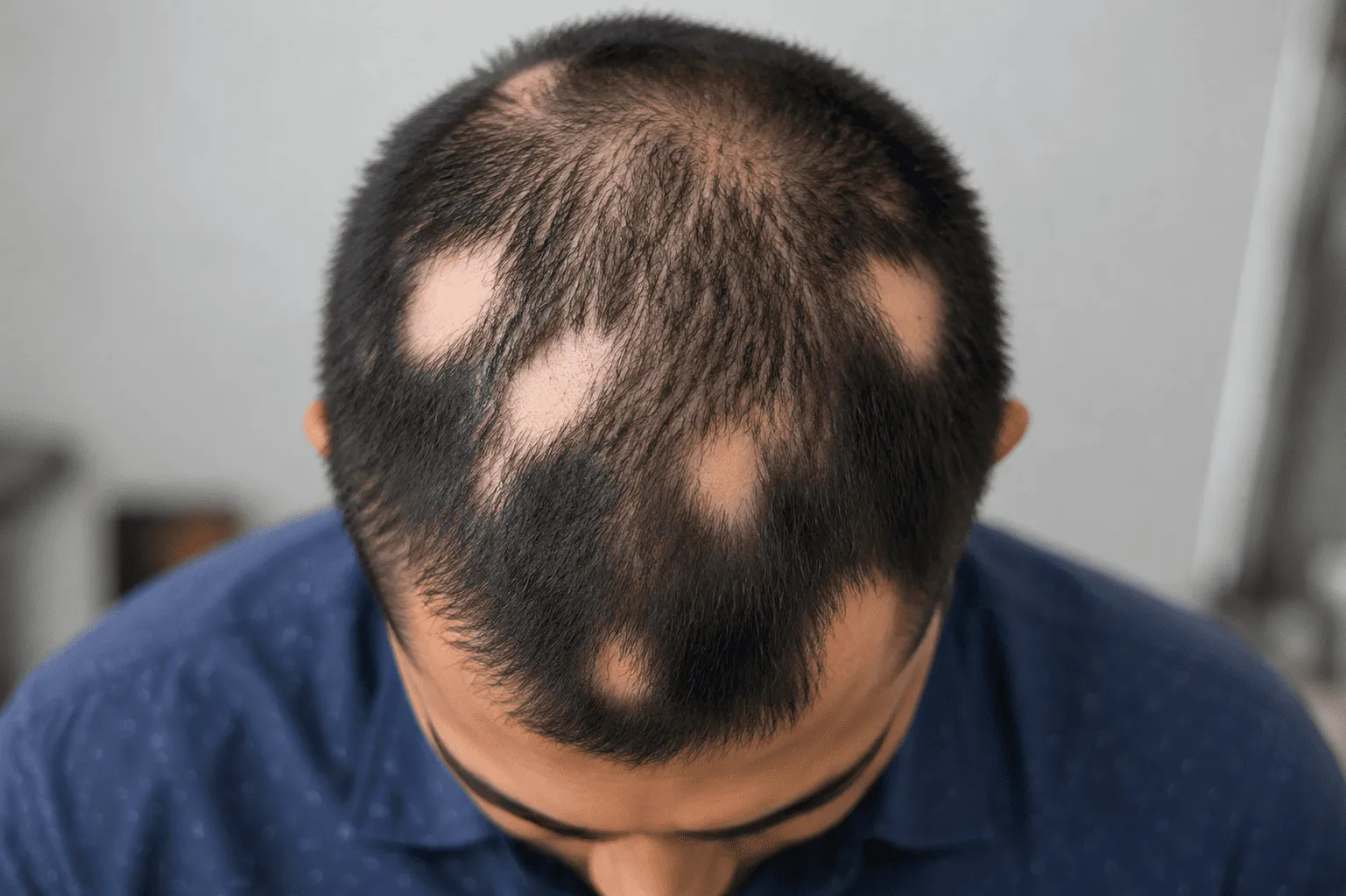 Alopecia Areata Treatment in Chennai
