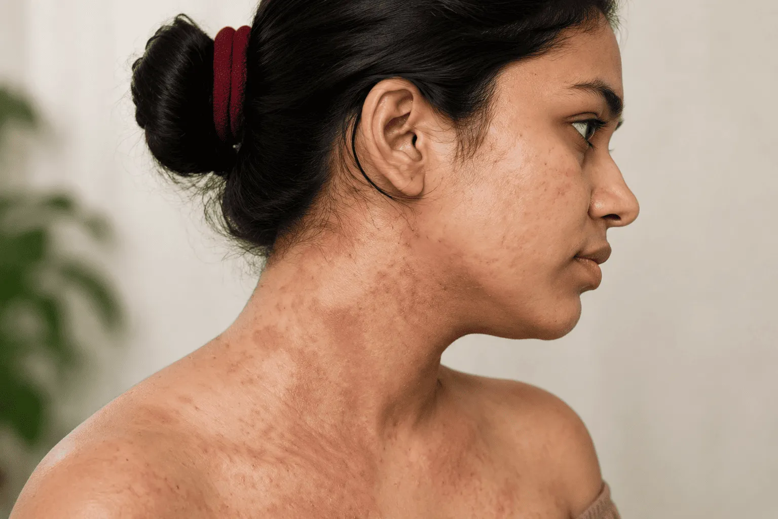 Psoriasis Types and Triggers